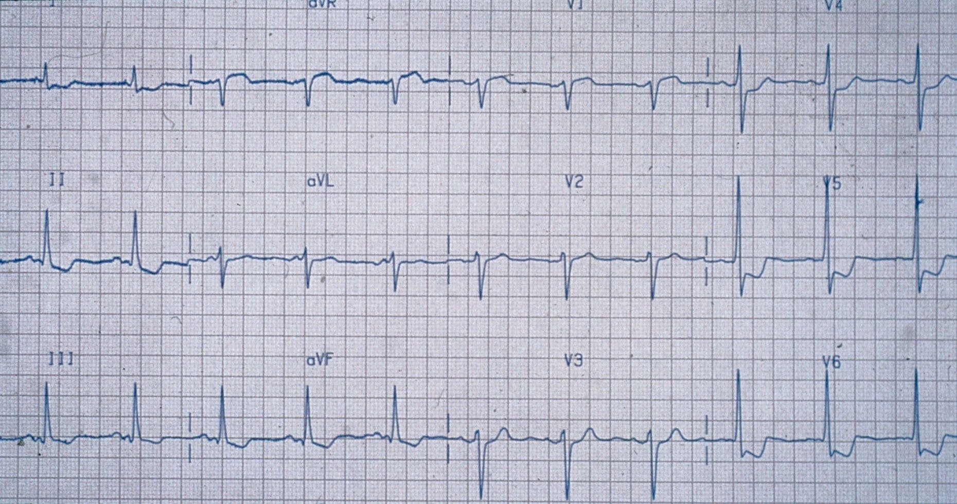 EKG-Kurve, blaue Linien, auf und ab, auf kariertem Papier.