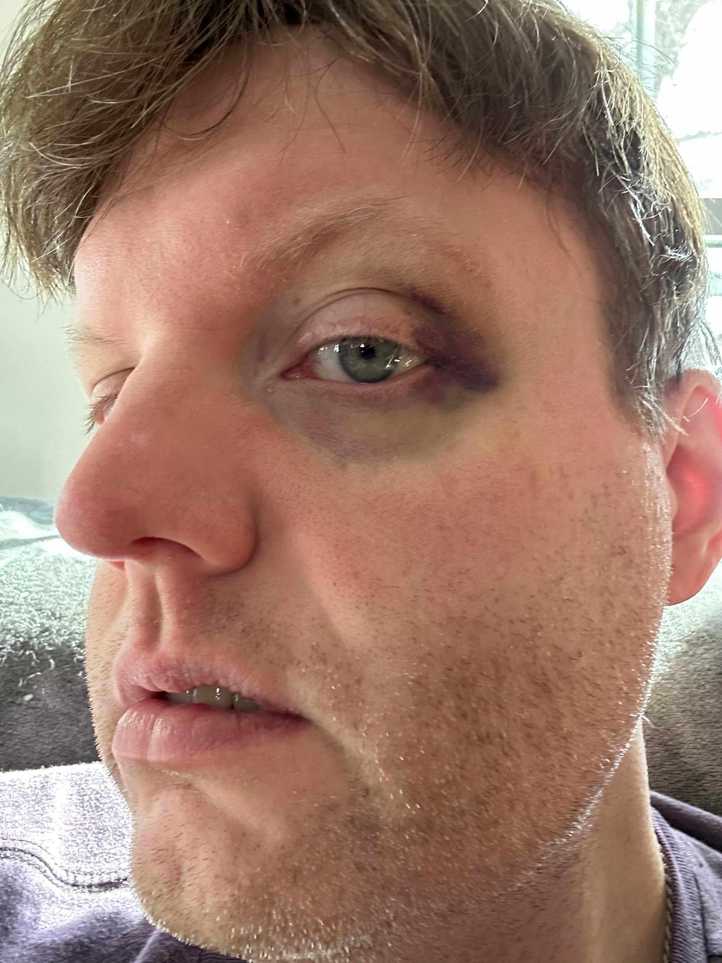 A selfie showcasing the bruising around the left half of my left eye. My hair is a mess and my face covered in stubble. I’m wearing a purple T-shirt and have my face half-turned to the camera.