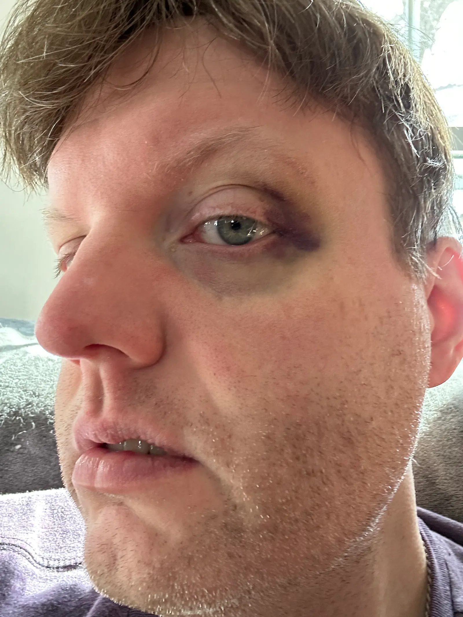 A selfie showcasing the bruising around the left half of my left eye. My hair is a mess and my face covered in stubble. I’m wearing a purple T-shirt and have my face half-turned to the camera.