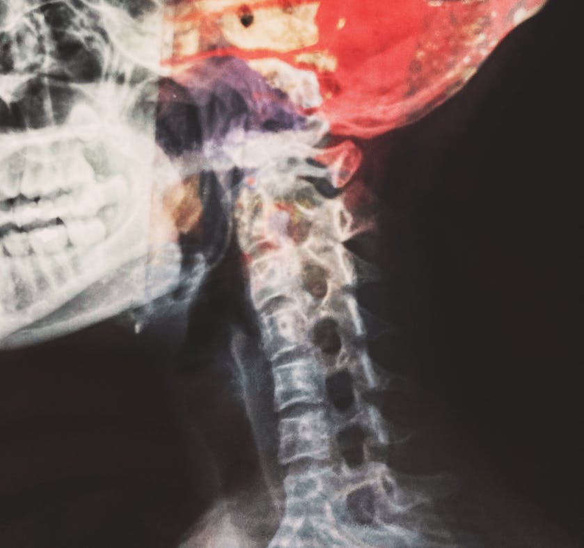 #057 Schleudertrauma #057 Schleudertrauma